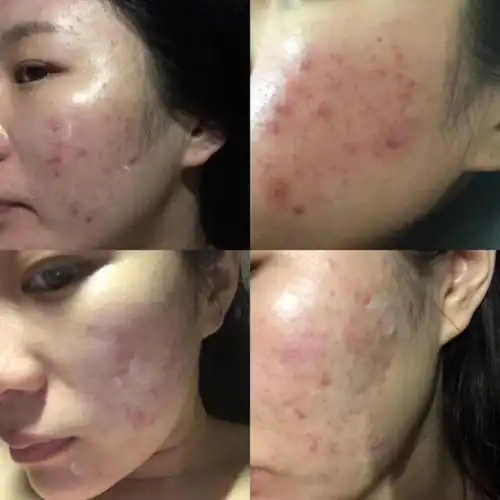 烂脸自救指南——果酸换肤