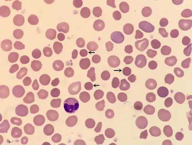 血涂片细胞学检查:成熟红细胞形态大小不一,嗜多色性红细胞易见,见