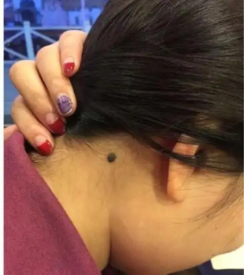 苦情痣人有什么特殊的福气