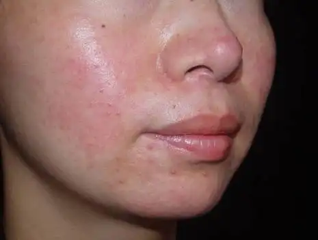 面部激素依赖性皮炎很痒老反复