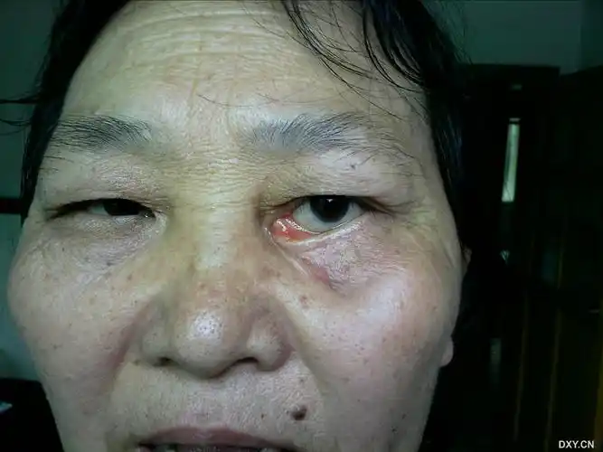 为求治疗今日来我院.触诊时感觉左眼下眶骨较右眼凹陷.