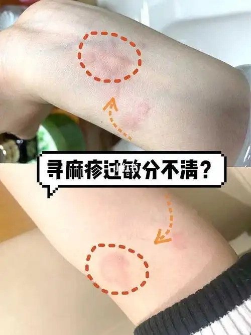 荨麻疹和过敏傻傻分不清皮肤病亲测无误