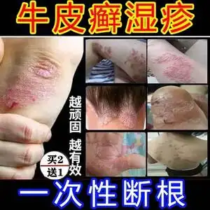治牛皮癣银屑病专用药顽固止痒去根皮肤全身干痒阴囊瘙痒外用药膏