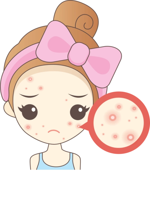 痤疮,多是青春期男女常见皮肤病,主要表现为红色丘疹,脓疱,结节,囊肿