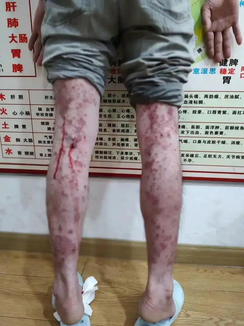 湿热造成的皮肤瘙痒 - 抖音