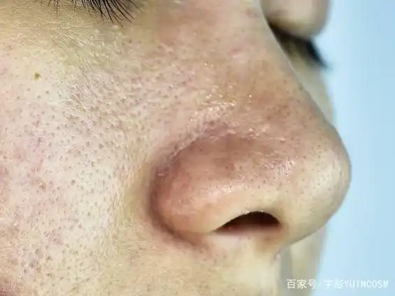 而且有些毛孔粗大,还伴随着爆痘,暗沉长斑等问题——油光型毛孔粗大.