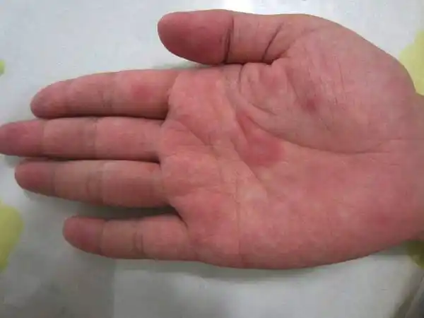 手掌胃区3种斑是胃病前兆!