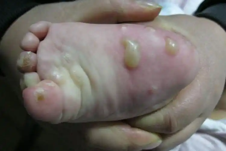 小孩子长疥疮的图片