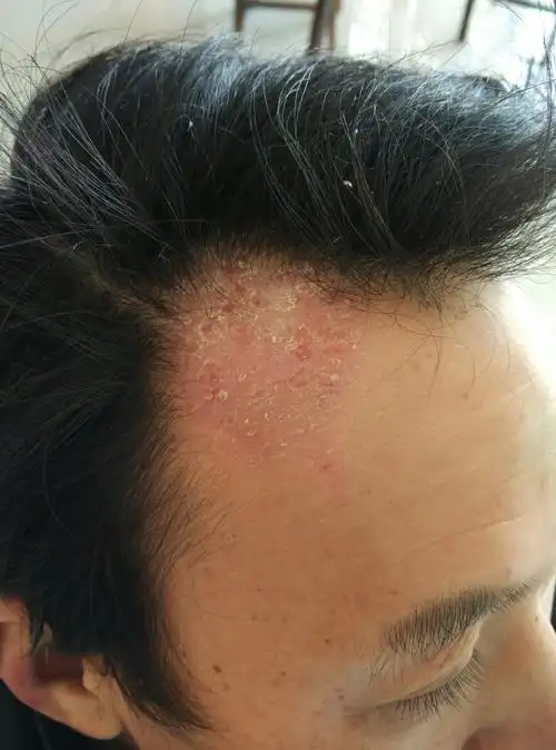 我爸爸头上长了一块癣,这是什么癣?怎么治?