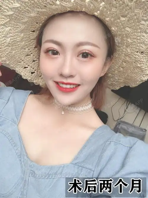 做的双眼皮能自然到什么程度