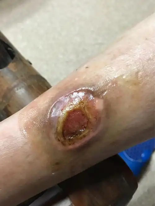 这是一个86岁老人的腿,由于30多年的糖尿病,老人的腿经常会发炎,溃烂.