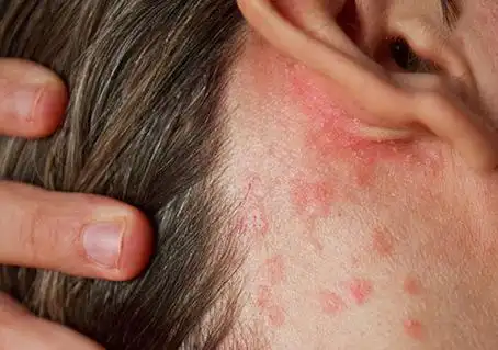 湿疹图片初期症状图片大全:耳朵,手掌手背,疱疹