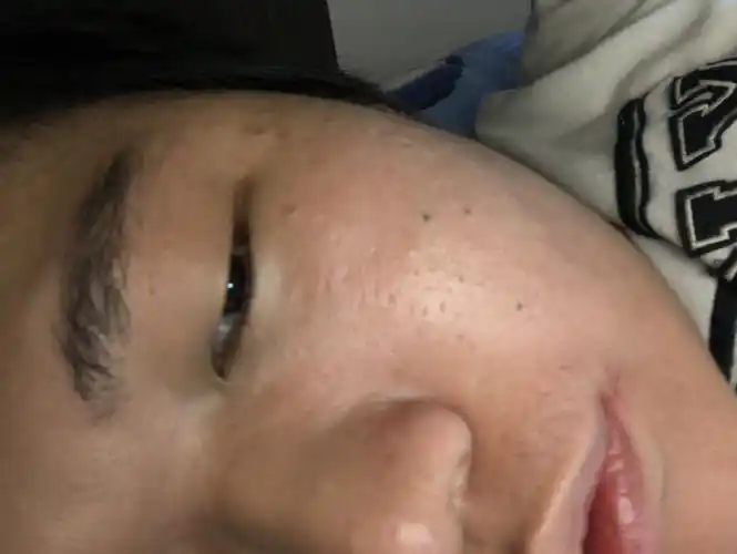 男生20岁 皮肤很粗糙 问题一直没解决 显老 毛孔粗大 怎么解决
