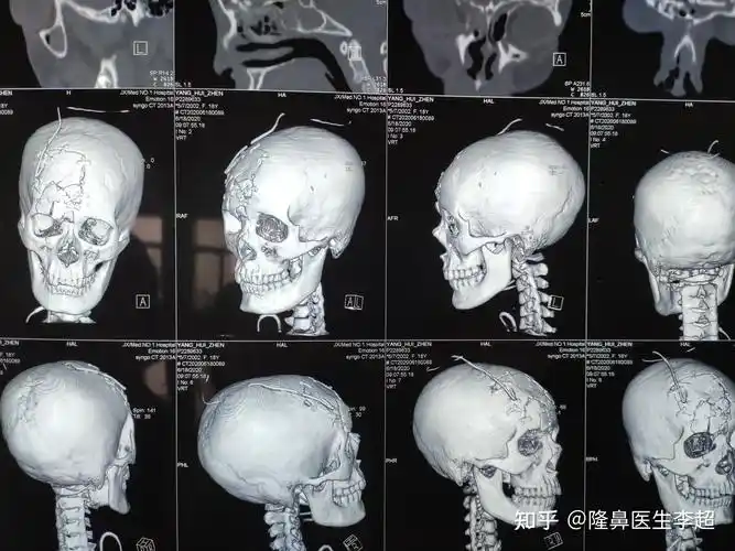 binder综合症有哪些症状?
