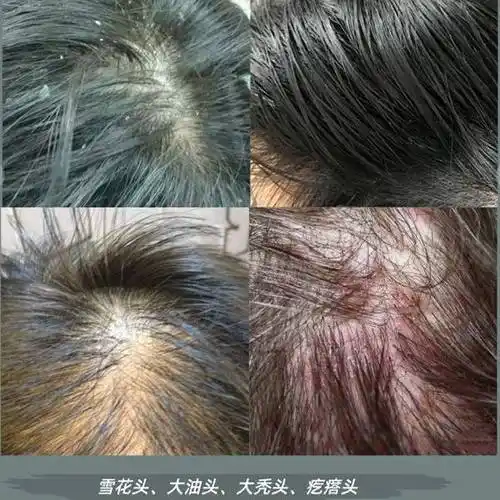 油性头头皮屑多用什么洗发水