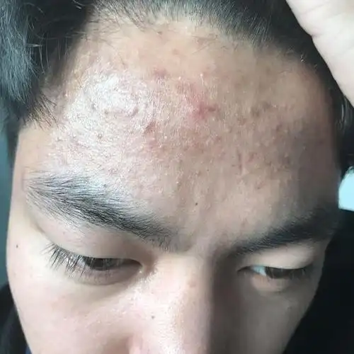 脸蛋,额头上却出现这些"小疙瘩",难看死了!