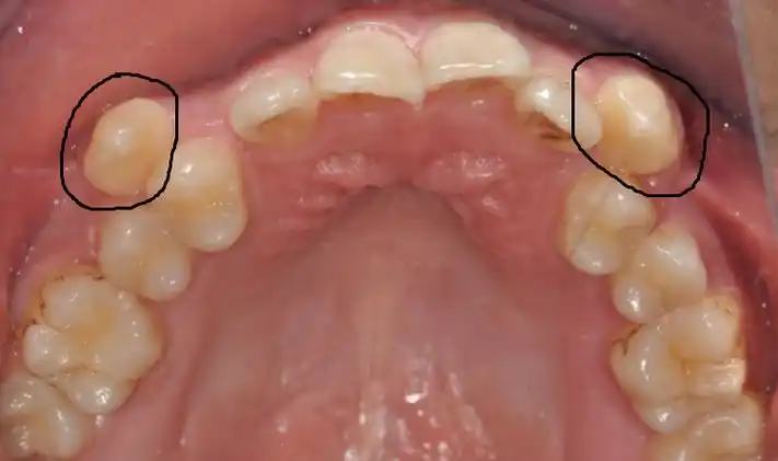 "虎牙"突出来,拔掉就好了?(口腔科普第十八期) - 好大夫在线