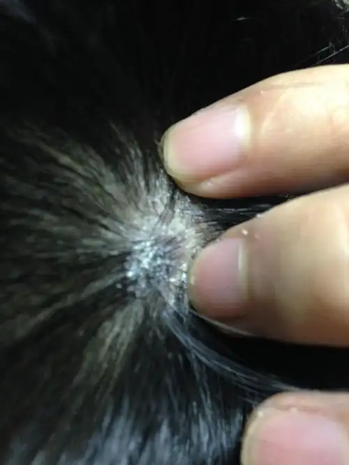 头皮上长了一些东西,不痛不痒没感觉,挠了会起皮屑!