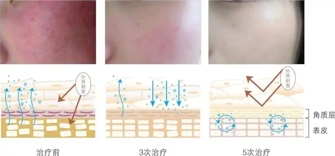 皮肤角质层受损能养回来吗