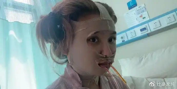 王思聪前女友晒轮廓整容术后52天照片,脸肿得像馒头被吐槽像人妖