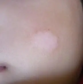 白癜风患者发病原因有哪些