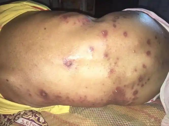 脑梗病史,现右侧肢体肌肉萎缩,活动受限,近期出现皮肤瘙痒后溃烂,主要