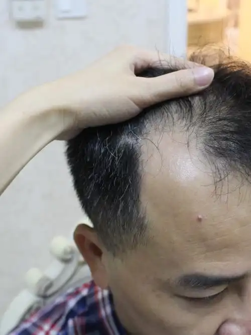 看下图,感觉还是有些稀疏,继续等等种植的头发开始脱_圈子-新氧美容