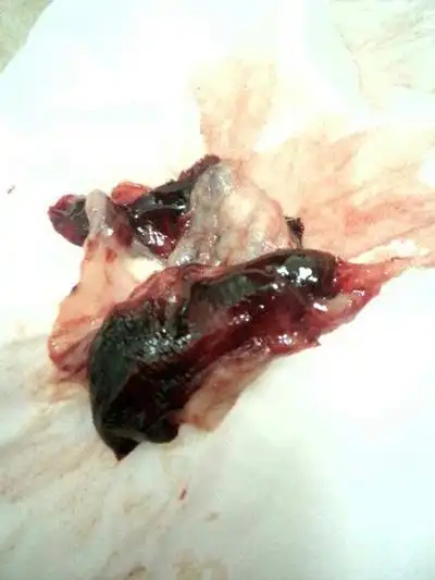 白带带血图片49