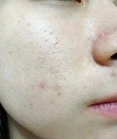 脸上的毛孔像一个个坑,用这3招来"补救",毛孔近看也看不见