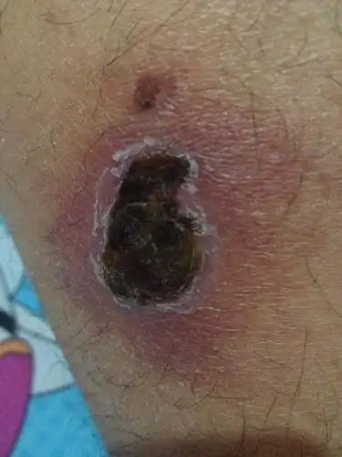 烫伤一个星期,结痂了,但是感觉还是有一点