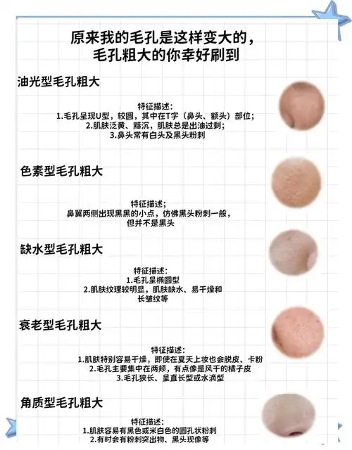 毛孔粗大?这些方法帮你改善!