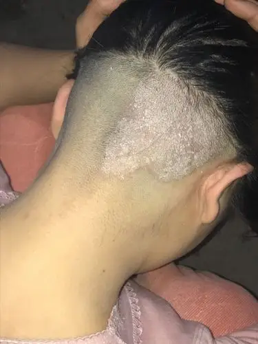 说痒得不得了,一抓还有很多头皮屑.