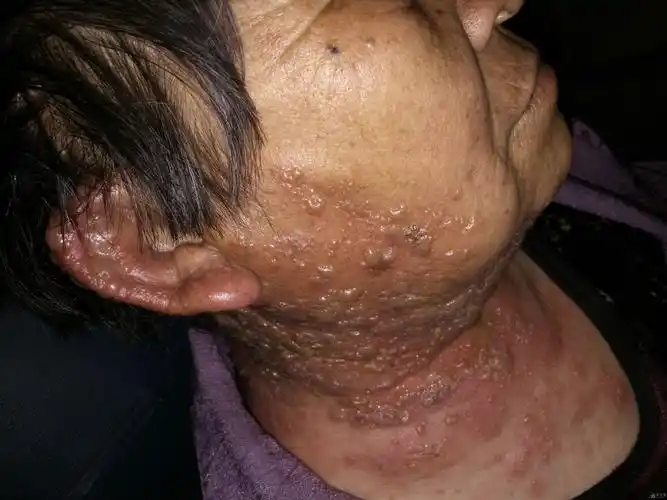 一例严重带状疱疹病例 合并躯体单纯疱疹病例 附图片 - 皮肤及性传播