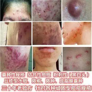 治疗丘疹型痤疮囊肿型脸部毛囊炎白头粉刺结节性痘痘疙瘩专用药膏