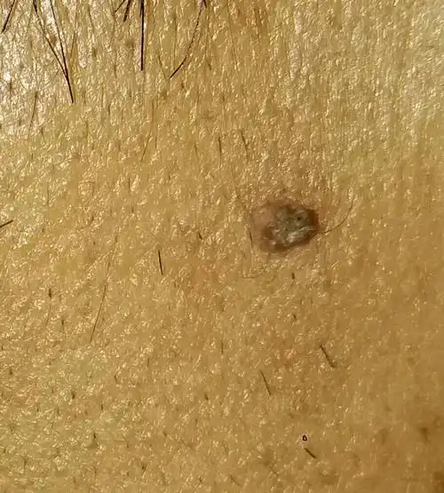 我脸上长了个肉包 顶端会变硬 变干 是怎么了?