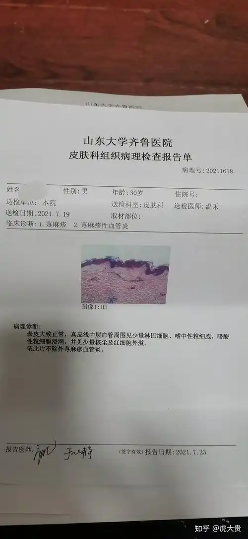 记录一下自己的荨麻疹性血管炎