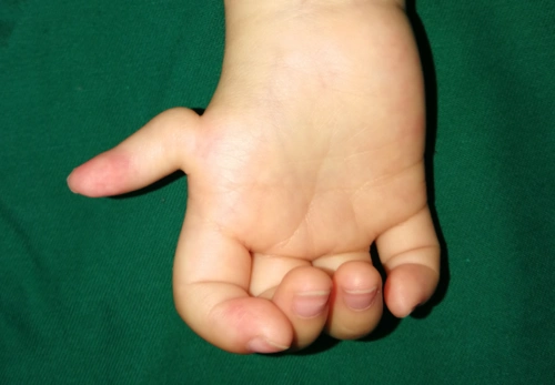 孕期做产检能不能检查出宝宝的手部畸形?