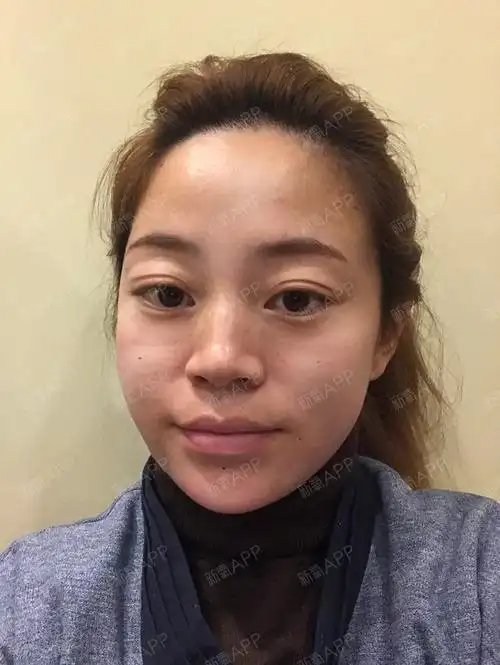 【脂肪填充全面部】术后3天