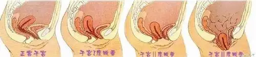 束腹带使用不当,可能会导致子宫下垂.