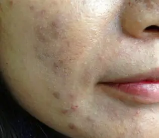 面部毛囊炎的症状特点有什么