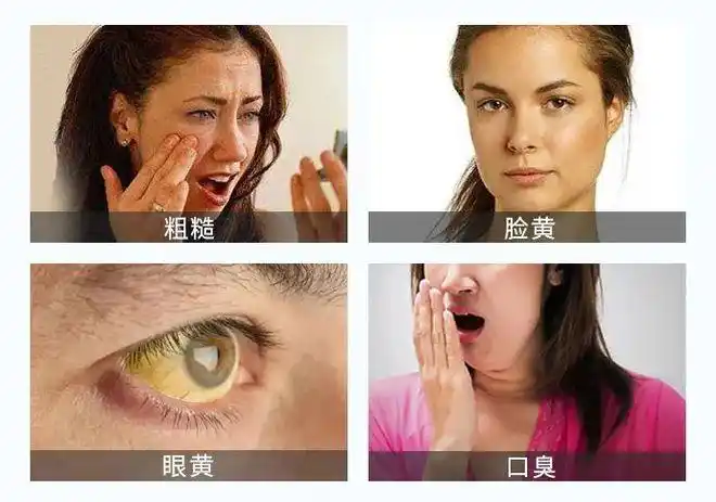 一长,肝不能正常工作,就会导致肝功能不畅,出现脸黄,皮肤粗糙,眼黄