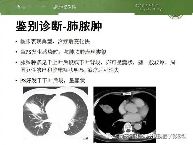 肺隔离症影像表现_郑孝飞