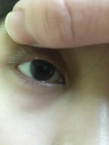 上眼皮边上长了一粒痘 这是长什么了 要怎么办