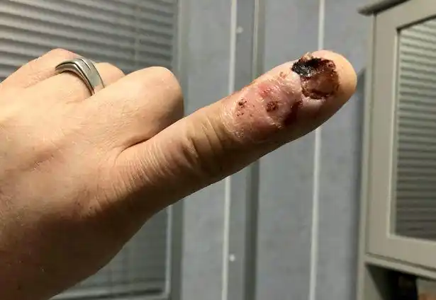 英国男子平时喜欢咬指甲,没想到这一坏习惯导致他险些丧命_网易订阅