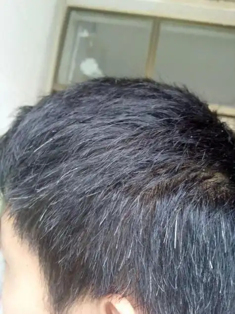 头顶白发咋治疗怎么预防(为何会长白头发)