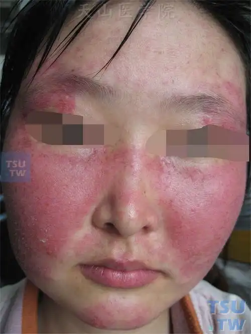 系统性红斑狼疮(sle)的症状表现 - 皮肤病学 - 天山医学院