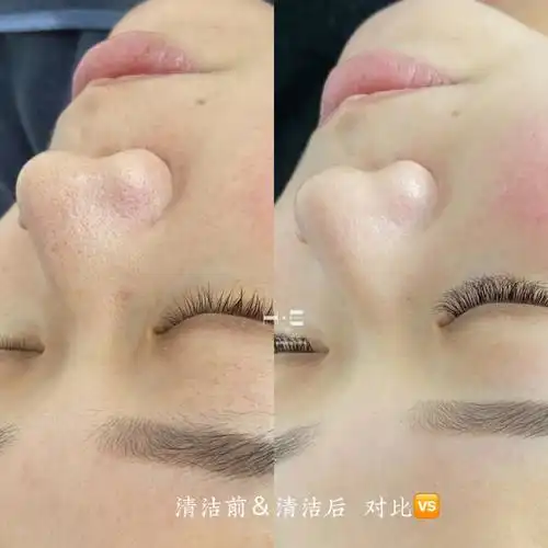 任丘皮肤管理清洁补水效果对比