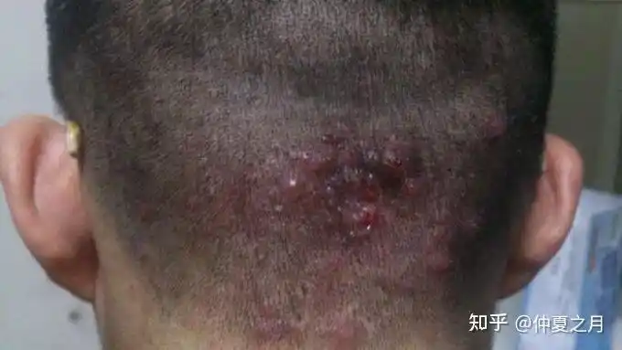 头皮毛囊炎怎么办?头皮长了很多痘痘怎么治? - 知乎
