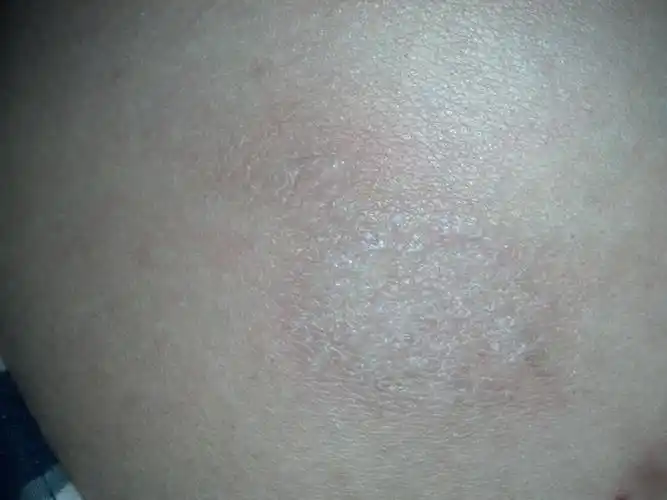 请问这是皮肤病么? 不痛不痒的~~长在后背的 担心是什么毛病