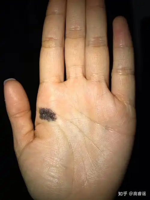 我的左手掌心有颗痣,突然很想找到右手掌心相同位置也有痣的人?